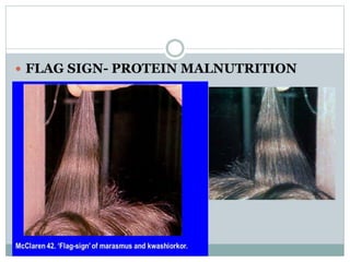 NFPE Micronutrient Deficiencies Hair Flashcards  Quizlet