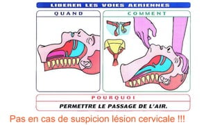 Pas en cas de suspicion lésion cervicale !!!
 