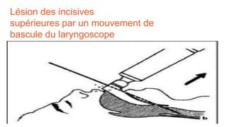 Lésion des incisives
supérieures par un mouvement de
bascule du laryngoscope
 