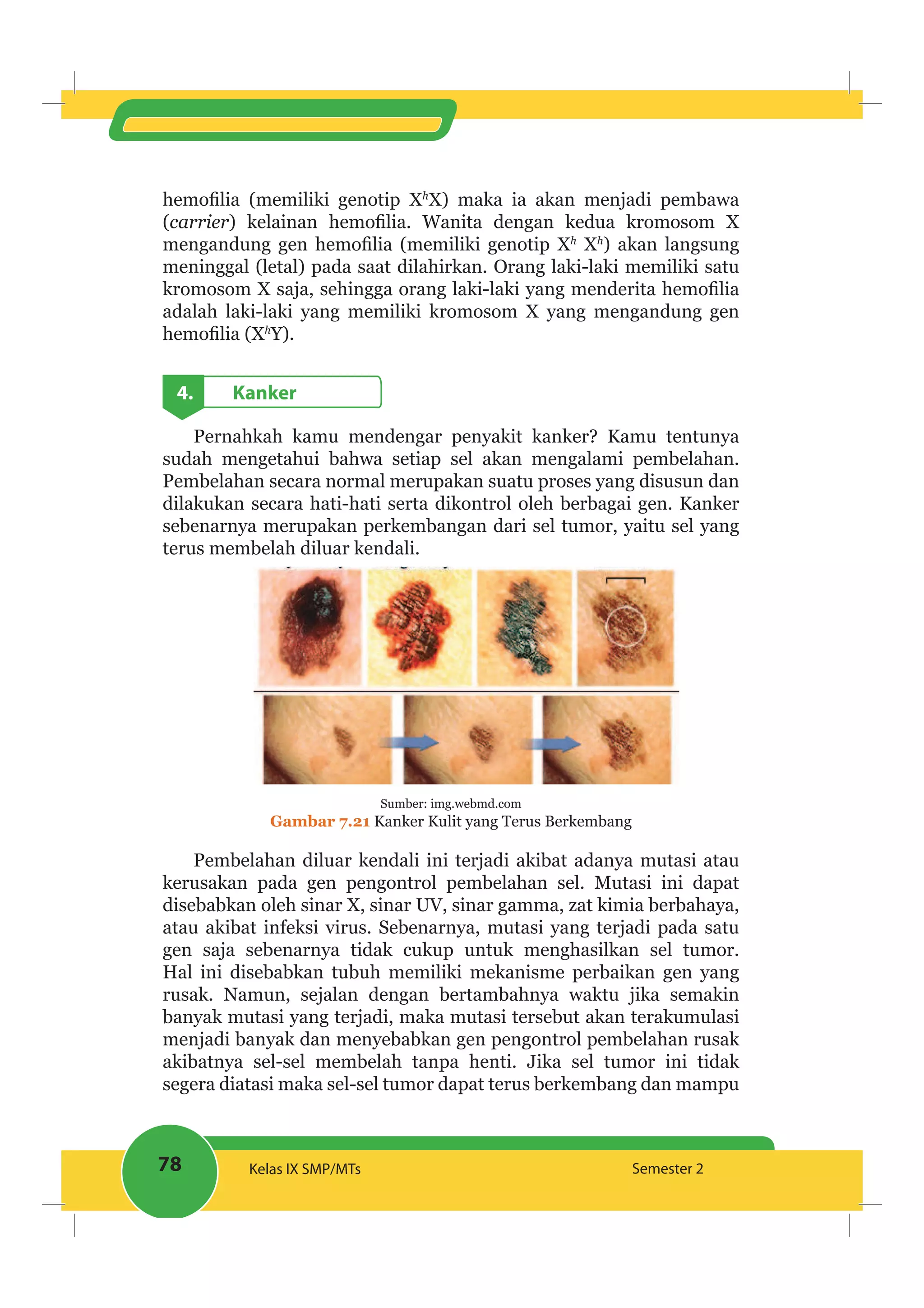 78 Kelas IX SMP/MTs Semester 2
h
X) maka ia akan menjadi pembawa
(carrier
h
Xh
) akan langsung
meninggal (letal) pada saat dilahirkan. Orang laki-laki memiliki satu
adalah laki-laki yang memiliki kromosom X yang mengandung gen
h
Y).
4. Kanker
Pernahkah kamu mendengar penyakit kanker? Kamu tentunya
sudah mengetahui bahwa setiap sel akan mengalami pembelahan.
Pembelahan secara normal merupakan suatu proses yang disusun dan
dilakukan secara hati-hati serta dikontrol oleh berbagai gen. Kanker
sebenarnya merupakan perkembangan dari sel tumor, yaitu sel yang
terus membelah diluar kendali.
Sumber: img.webmd.com
Gambar 7.21 Kanker Kulit yang Terus Berkembang
Pembelahan diluar kendali ini terjadi akibat adanya mutasi atau
kerusakan pada gen pengontrol pembelahan sel. Mutasi ini dapat
disebabkan oleh sinar X, sinar UV, sinar gamma, zat kimia berbahaya,
atau akibat infeksi virus. Sebenarnya, mutasi yang terjadi pada satu
gen saja sebenarnya tidak cukup untuk menghasilkan sel tumor.
Hal ini disebabkan tubuh memiliki mekanisme perbaikan gen yang
rusak. Namun, sejalan dengan bertambahnya waktu jika semakin
banyak mutasi yang terjadi, maka mutasi tersebut akan terakumulasi
menjadi banyak dan menyebabkan gen pengontrol pembelahan rusak
akibatnya sel-sel membelah tanpa henti. Jika sel tumor ini tidak
segera diatasi maka sel-sel tumor dapat terus berkembang dan mampu
 