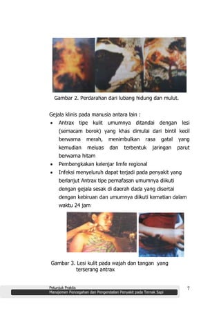 Petunjuk Praktis
Manajemen Pencegahan dan Pengendalian Penyakit pada Ternak Sapi
7
Gambar 2. Perdarahan dari lubang hidung dan mulut.
Gejala klinis pada manusia antara lain :
Antrax tipe kulit umumnya ditandai dengan lesi
(semacam borok) yang khas dimulai dari bintil kecil
berwarna merah, menimbulkan rasa gatal yang
kemudian meluas dan terbentuk jaringan parut
berwarna hitam
Pembengkakan kelenjar limfe regional
Infeksi menyeluruh dapat terjadi pada penyakit yang
berlanjut Antrax tipe pernafasan umumnya diikuti
dengan gejala sesak di daerah dada yang disertai
dengan kebiruan dan umumnya diikuti kematian dalam
waktu 24 jam
Gambar 3. Lesi kulit pada wajah dan tangan yang
terserang antrax
 