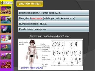 1 
2 
3 
4 
5 
6 
7 
SINDROM TURNER 
Ditemukan oleh H.H Turner pada 1938. 
Mengalami monosomi (kehilangan satu kromosom X). 
Rumus kromosom: 45,X0. 
Penderitanya perempuan. 
Perempuan penderita sindrom Turner 
Sindrom Turner (45,X0) 
 