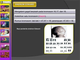 1 
2 
3 
4 
5 
6 
7 
SSIINNDDRROOMM EEDDWWAARRDD 
Mengalami gagal berpisah pada kromosom 16,17, dan 18. 
Kelebihan satu kromosom (trisomi). 
Rumus kromosom: laki-laki = 47,XY + 18; perempuan: 47,XX + 18. 
Bayi penderita sindrom Edward 
 