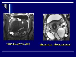 TUBA-OVARYAN ABSE BİLATERAL İ۰ʷ
 