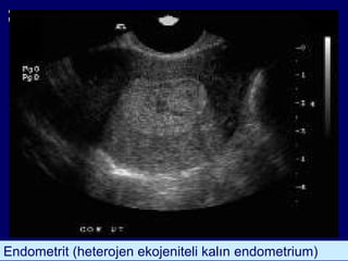 Endometrit (heterojen ekojeniteli kalın endometrium)
 