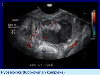 Pyosalpinks (tubo-ovarian kompleks)
 