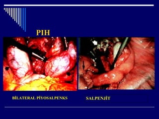 PIH
BİLATERAL İ۰ʷ SALPENJİT
 