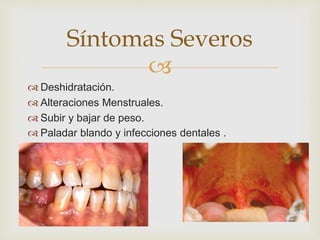 Síntomas Severos 
 
 Deshidratación. 
 Alteraciones Menstruales. 
 Subir y bajar de peso. 
 Paladar blando y infecciones dentales . 
 