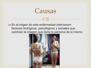 Causas 
 
 En el origen de esta enfermedad intervienen 
factores biológicos, psicológicos y sociales que 
cambian la imagen que tiene la persona de si mismo 
 