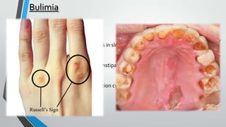 Bulimia
Síntomas
o Apathy, fatigue and changes in sleeping rhythm.

Decrease of
the scholar or
labour
performance.

o Abdominal damage with constipation, lack of tooth enamel, damage in the
throat…

o Irregularity in the menstruation cycle.

 