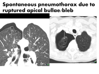 Bullae Back Bullae Bleb Cavitas dan teman temannya.pdf