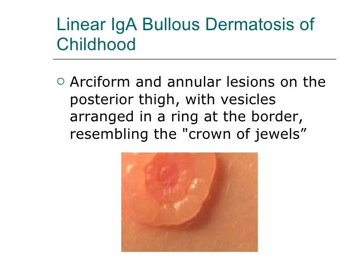 Linear IgA bullous dermatosis II