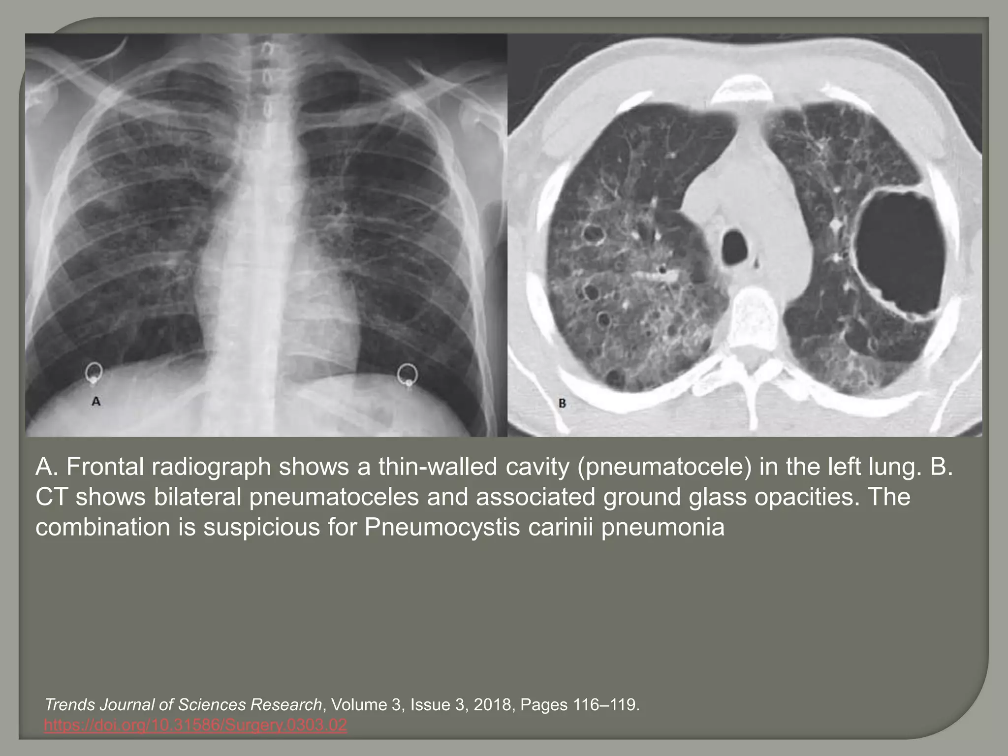 A. Frontal radiograph shows a thin-walled cavity (pneumatocele) in the left lung. B.
CT shows bilateral pneumatoceles and associated ground glass opacities. The
combination is suspicious for Pneumocystis carinii pneumonia
Trends Journal of Sciences Research, Volume 3, Issue 3, 2018, Pages 116–119.
https://doi.org/10.31586/Surgery.0303.02
 