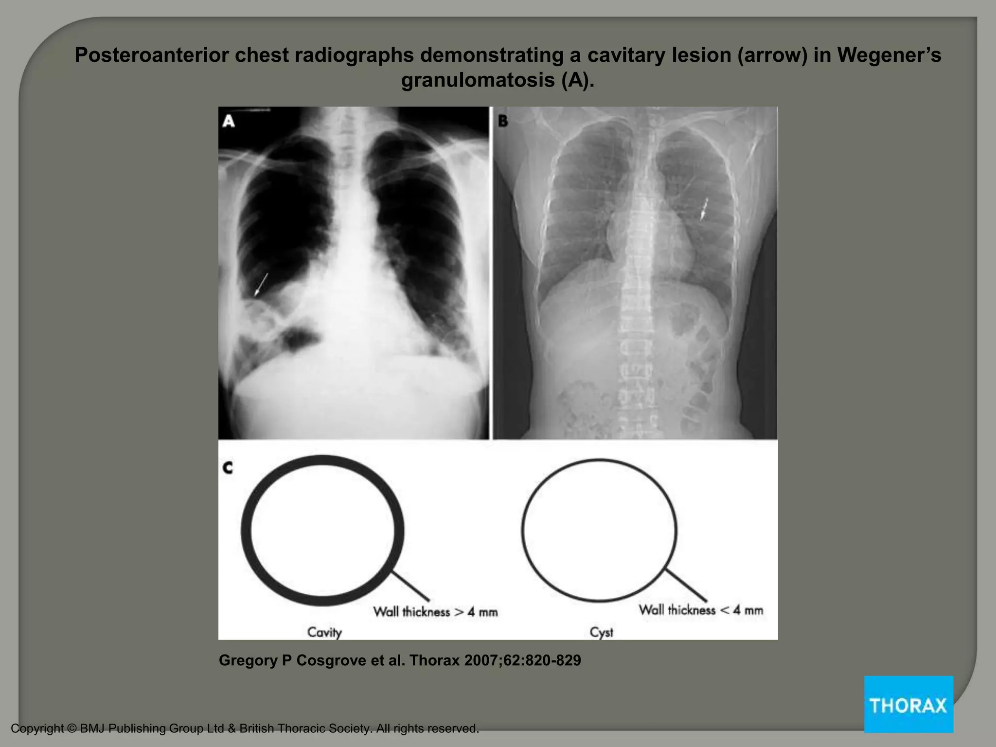 Posteroanterior chest radiographs demonstrating a cavitary lesion (arrow) in Wegener’s
granulomatosis (A).
Gregory P Cosgrove et al. Thorax 2007;62:820-829
Copyright © BMJ Publishing Group Ltd & British Thoracic Society. All rights reserved.
 