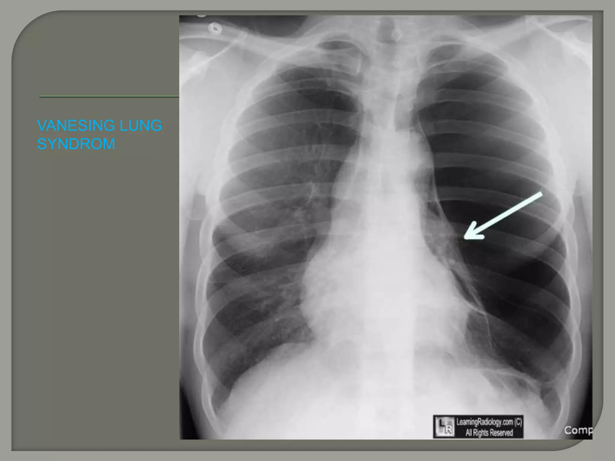 VANESING LUNG
SYNDROM
 