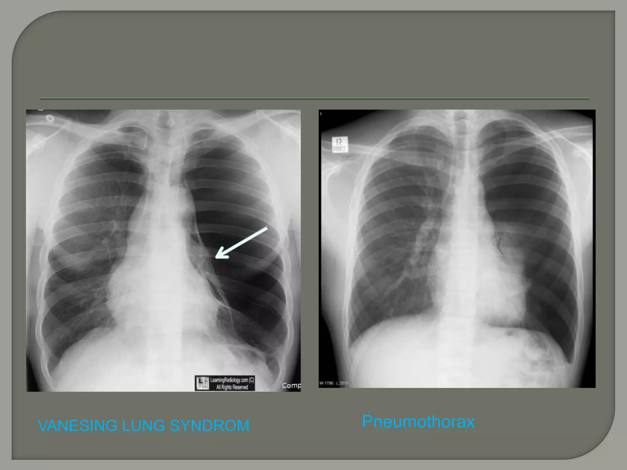 VANESING LUNG SYNDROM Pneumothorax
 
