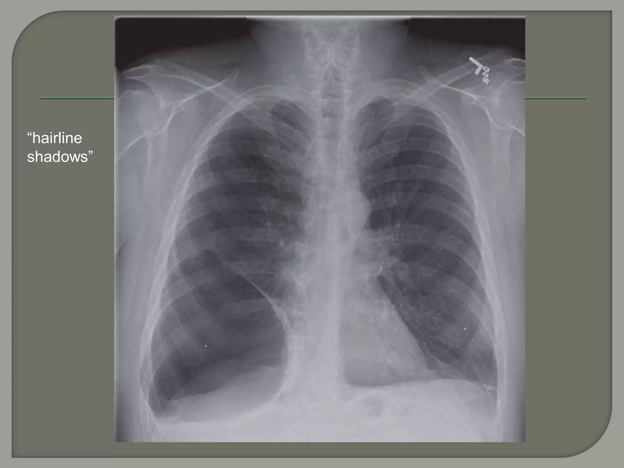 “hairline
shadows”
 