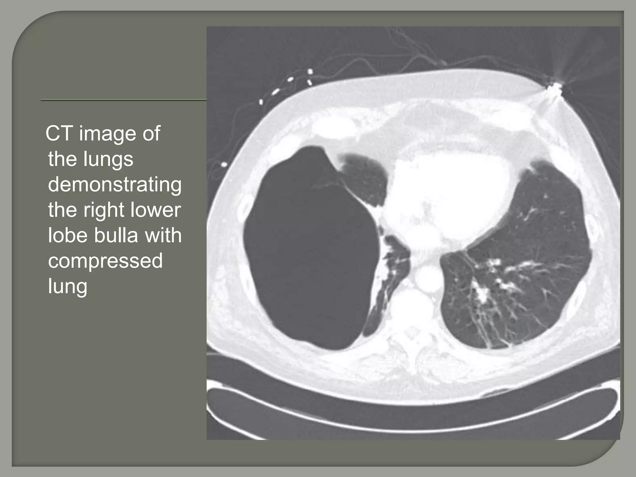 CT image of
the lungs
demonstrating
the right lower
lobe bulla with
compressed
lung
 