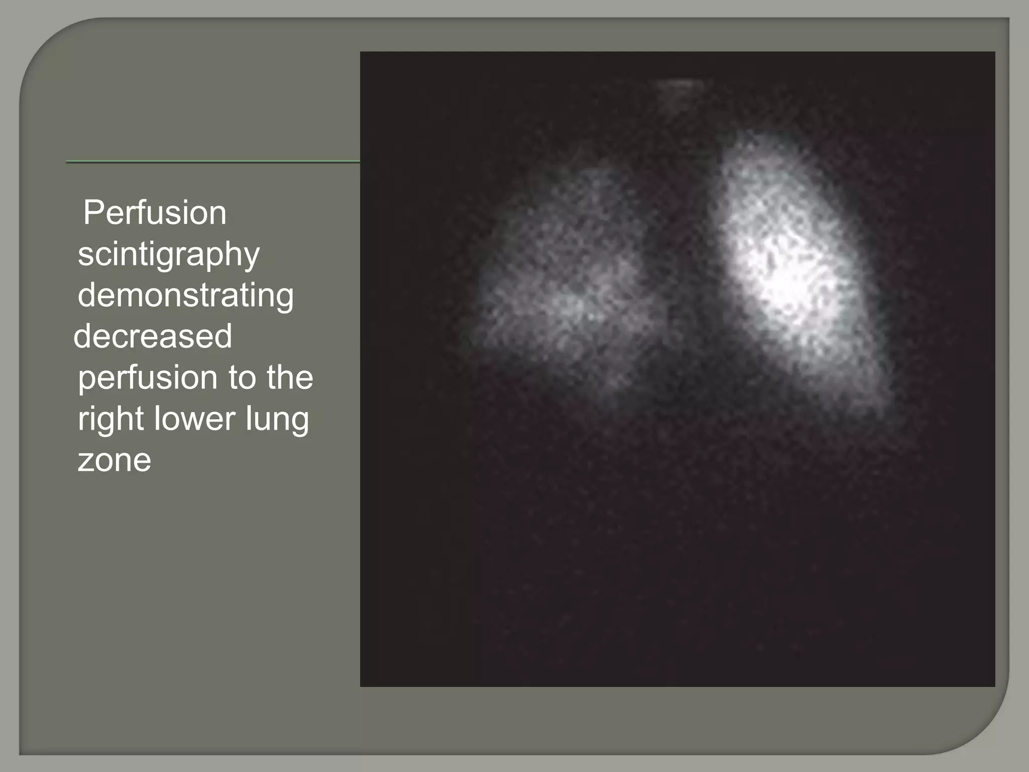 Perfusion
scintigraphy
demonstrating
decreased
perfusion to the
right lower lung
zone
 