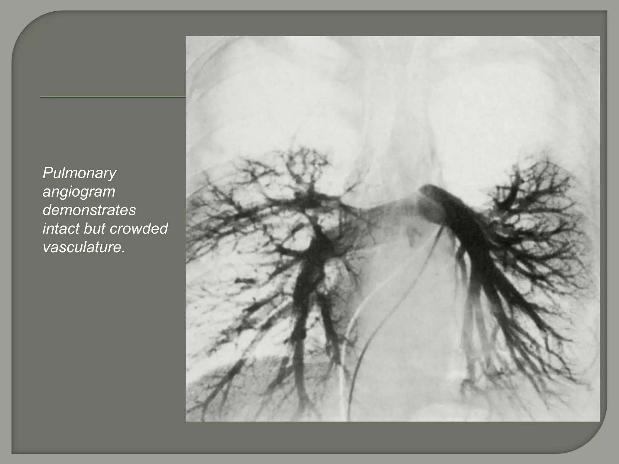 Pulmonary
angiogram
demonstrates
intact but crowded
vasculature.
 