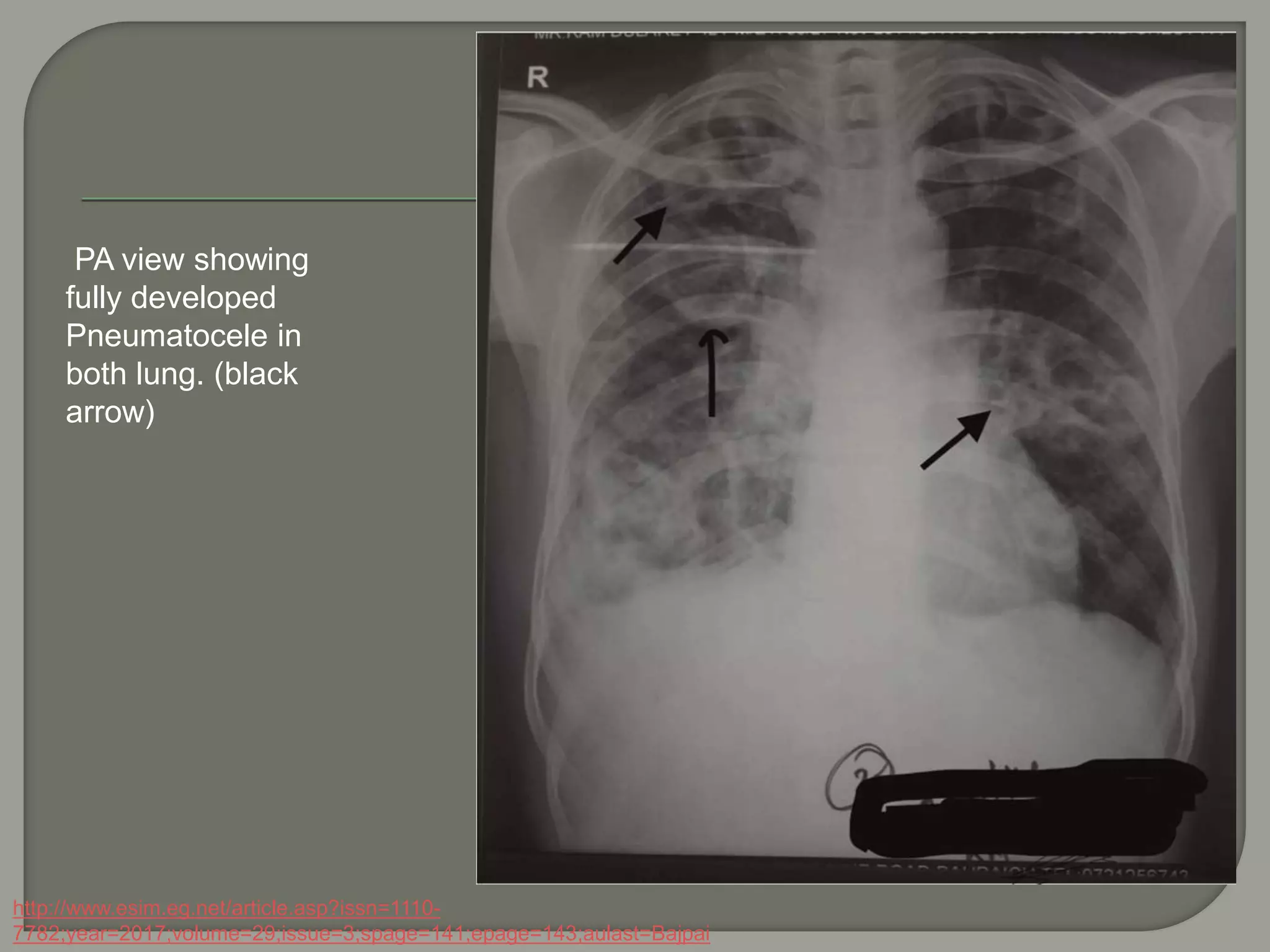 PA view showing
fully developed
Pneumatocele in
both lung. (black
arrow)
http://www.esim.eg.net/article.asp?issn=1110-
7782;year=2017;volume=29;issue=3;spage=141;epage=143;aulast=Bajpai
 