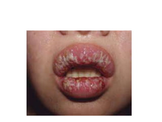 Bullous Face Bullous disease of the skin.pptx