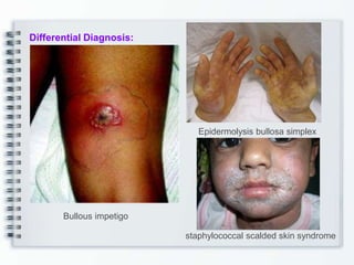 Epidermolysis bullosa simplex
Bullous impetigo
Differential Diagnosis:
staphylococcal scalded skin syndrome
 