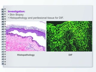 Investigation:
• Skin Biopsy
• Histopathology and perilesional tissue for DIF.
Histopathology DIF
 