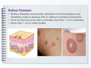 • Bullous diseases are broadly classified as immunobullous and
hereditary bullous disease with or without mucosal involvement.
• Fluid containing cavity with a diameter less than 1 cm in diameter.
• More than 1 cm is called bullae.
 