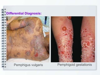 Differential Diagnosis:
Pemphigus vulgaris Pemphigoid gestationis
 