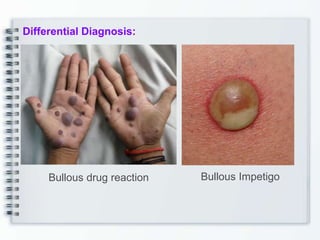 Differential Diagnosis:
Bullous Impetigo
Bullous drug reaction
 