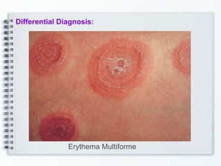 Differential Diagnosis:
Erythema Multiforme
 