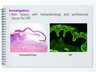Investigation:
• Skin biopsy with histopathology and perilesional
tissue for DIF.
Histopathology DIF
 