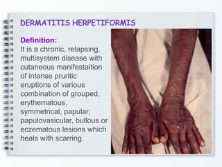 Definition:
It is a chronic, relapsing,
multisystem disease with
cutaneous manifestaition
of intense pruritic
eruptions of various
combination of grouped,
erythematous,
symmetrical, papular,
papulovasicular, bullous or
eczematous lesions which
heals with scarring.
 