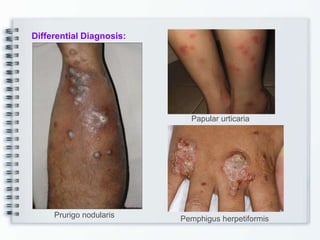 Differential Diagnosis:
Prurigo nodularis
Papular urticaria
Pemphigus herpetiformis
 