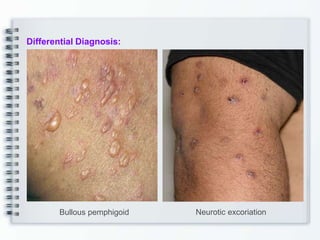 Differential Diagnosis:
Bullous pemphigoid Neurotic excoriation
 