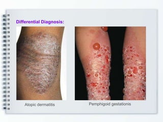 Differential Diagnosis:
Atopic dermatitis Pemphigoid gestationis
 