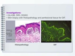 Investigations:
• HLA B8, DR3, DQW2.
• Skin biopsy with Histopathology and perilesional tissue for DIF.
Histopathology DIF
 