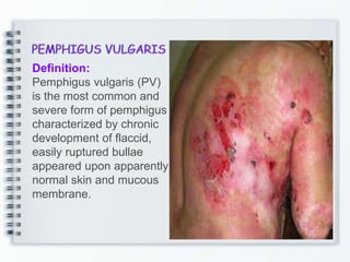 Definition:
Pemphigus vulgaris (PV)
is the most common and
severe form of pemphigus
characterized by chronic
development of flaccid,
easily ruptured bullae
appeared upon apparently
normal skin and mucous
membrane.
 
