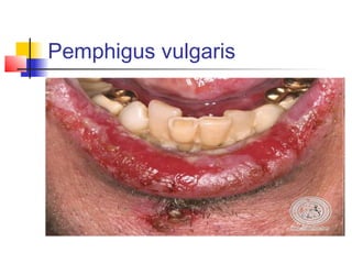 Pemphigus vulgaris
 