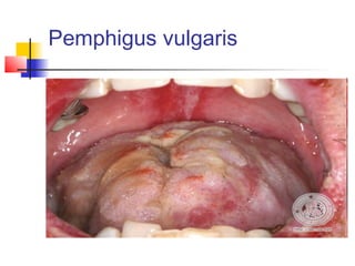 Pemphigus vulgaris
 