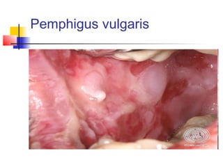 Pemphigus vulgaris
 