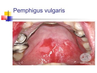 Pemphigus vulgaris
 