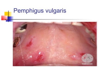 Pemphigus vulgaris
 