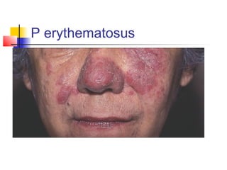 P erythematosus
 