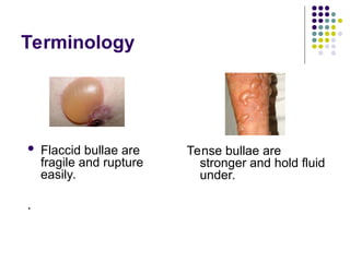 Comprehensive Overview of Bullous Pemphigoid: Pathophysiology ...