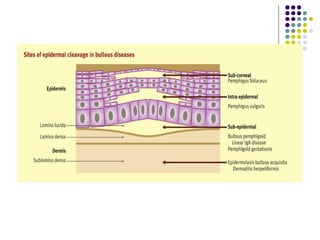 Bullous Process Comprehensive Overview of Bullous Pemphigoid: Pathophysiology ...