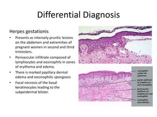 Differential Diagnosis
Herpes gestationis
• Presents as intensely pruritic lesions
on the abdomen and extremities of
pregnant women in second and third
trimesters.
• Perivascular infiltrate composed of
lymphocytes and eosinophils in zones
of erythema and edema.
• There is marked papillary dermal
edema and eosinophilic spongiosis
• Focal necrosis of the basal
keratinocytes leading to the
subpeidermal blister.
 
