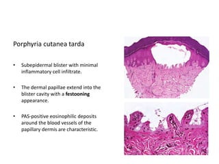 Porphyria cutanea tarda
• Subepidermal blister with minimal
inflammatory cell infiltrate.
• The dermal papillae extend into the
blister cavity with a festooning
appearance.
• PAS-positive eosinophilic deposits
around the blood vessels of the
papillary dermis are characteristic.
 