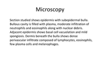 Microscopy
Section studied shows epidermis with subepidermal bulla.
Bullous cavity is filled with plasma, moderate infiltration of
neutrophils and eosinophils along with nuclear debris.
Adjacent epidermis shows basal cell vacuolation and mild
spongiosis. Dermis beneath the bulla shows dense
perivascular infiltrate composed of lymphocytes, eosinophils,
few plasma cells and melanophages.
 
